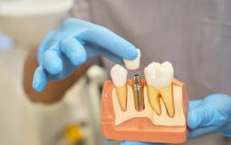 Cyrkonowe czy tytanowe implanty zębów – które wybrać?
